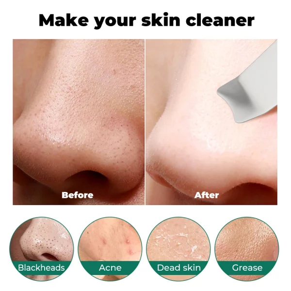 Peeling Ultrasonique Avancé Supprime les Points Noirs et Raffermit la Peau – Image 6