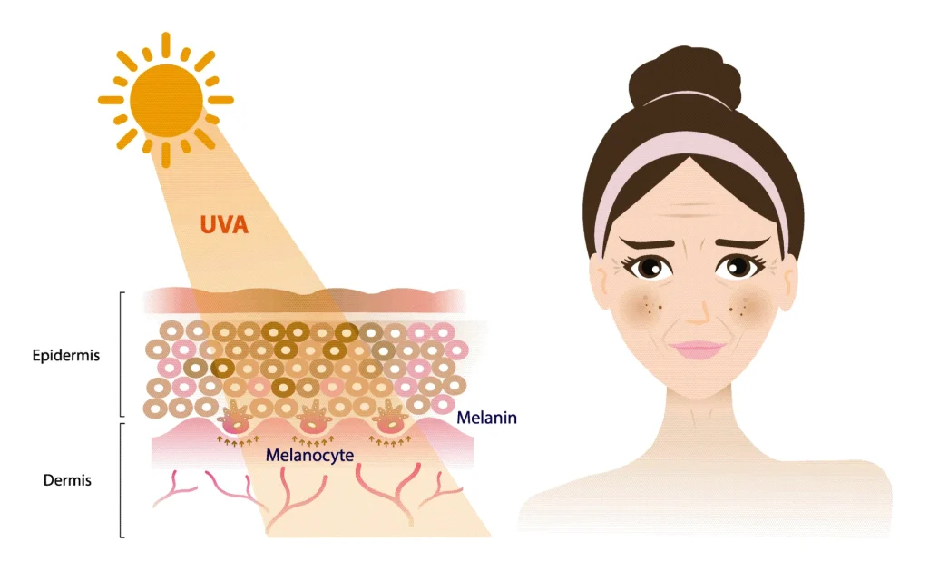 schema protection de la peau hyperpigmentée contre le soleil